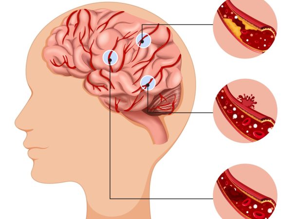 Accidentul Vascular Cerebral (AVC)